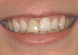Central Incisor 8 before