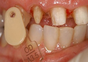 Opacious dentin cervical shade