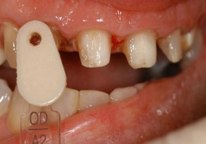 Opacious dentin prep shade
