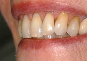 Upper lateral incisor 10